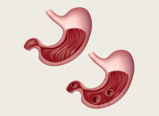 Gastric and Duodenal Ulcers (Peptic Ulcer Disease) consultation at Niraaya Hospital